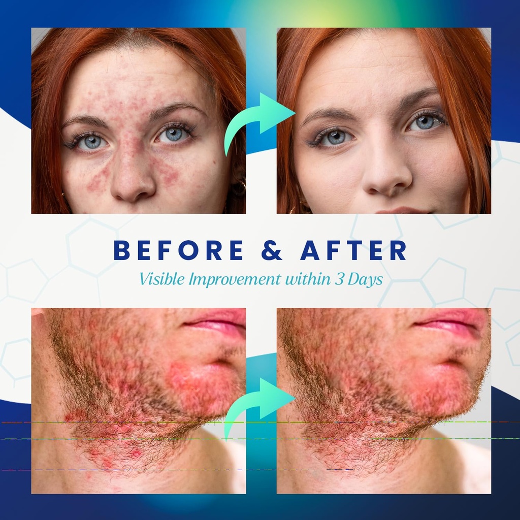 seborrheic-dermatitis-psoriasis-cream-an-4.jpg
