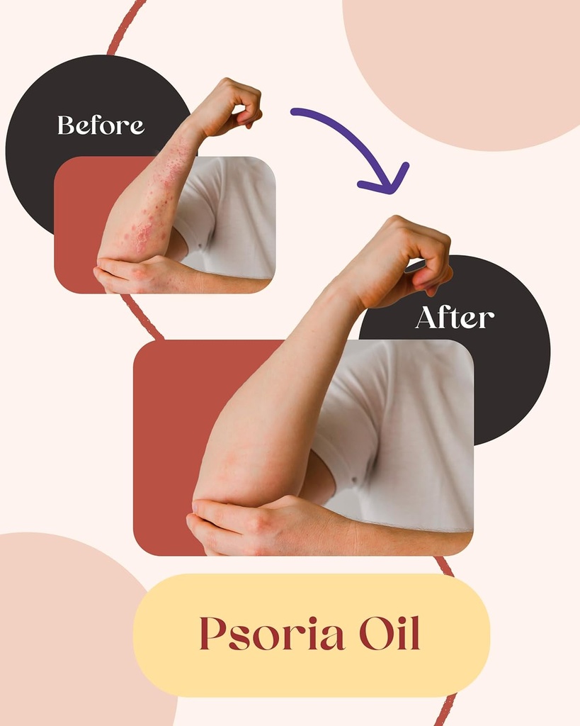 siya-ayurveda-psoriasis-treatment-oil-fo-3.jpg