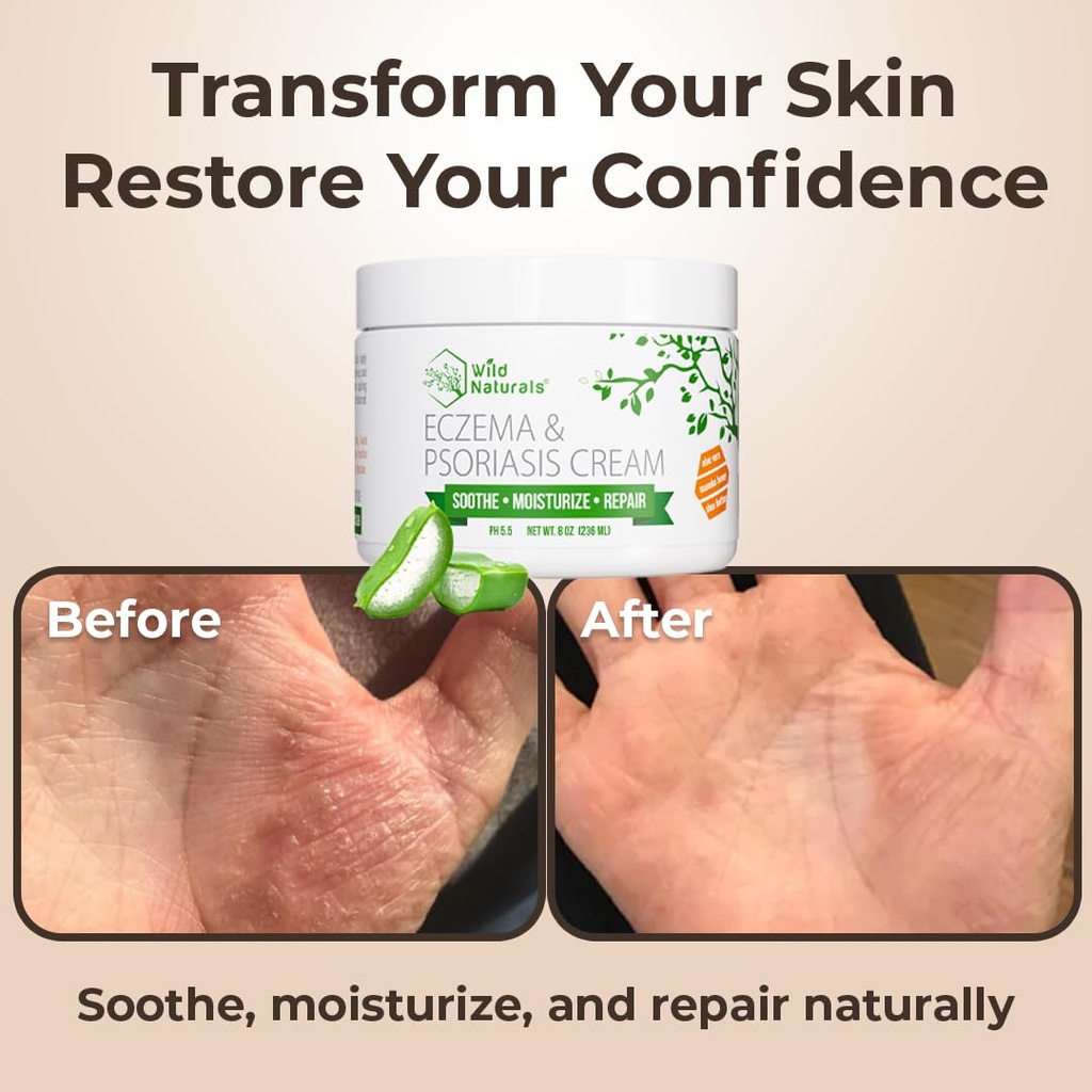wild-naturals-eczema-psoriasis-cream-for-5.jpg