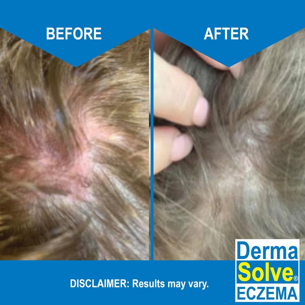dermasolve-eczema-relief-shampoo---flare-5.jpg