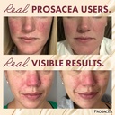 prosacea---medicated-rosacea-treatment-f-3.jpg