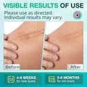 silicone-scar-gel-for-stretch-mark-100-s-2.jpg