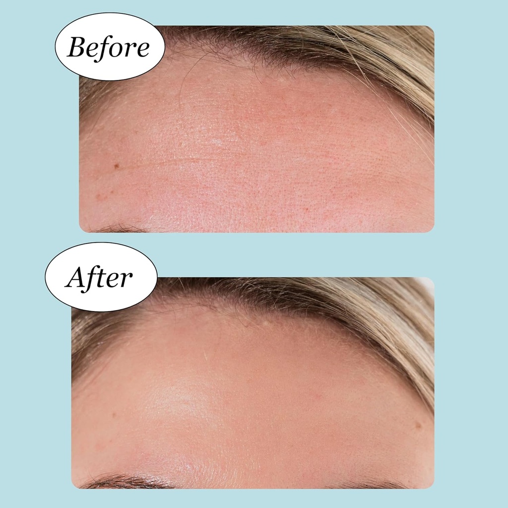 forehead-wrinkle-patches---anti-wrinkle--3.jpg