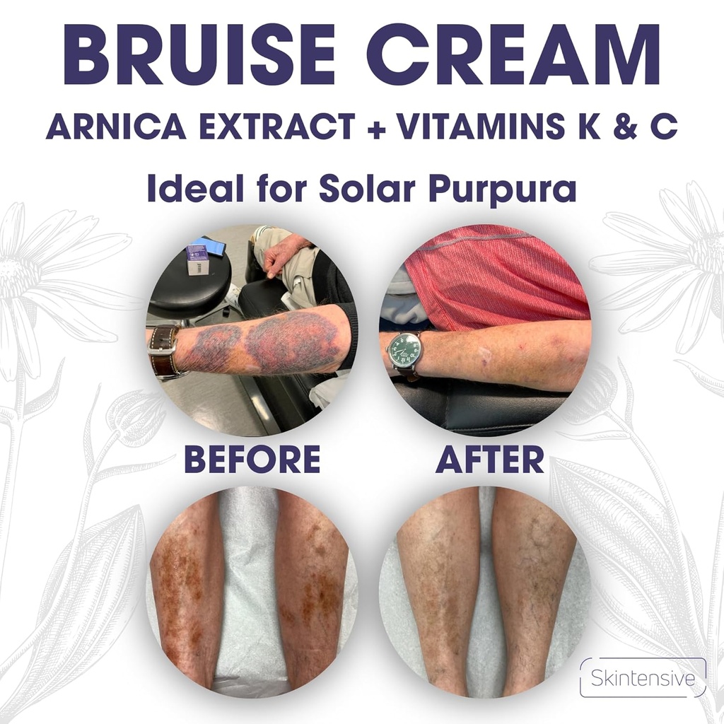 SKINTENSIVE Arnica Bruise Cream for Thin Skin - Moisturizing, Vitamin K C and E, Skin Renewal, 4 Oz 6