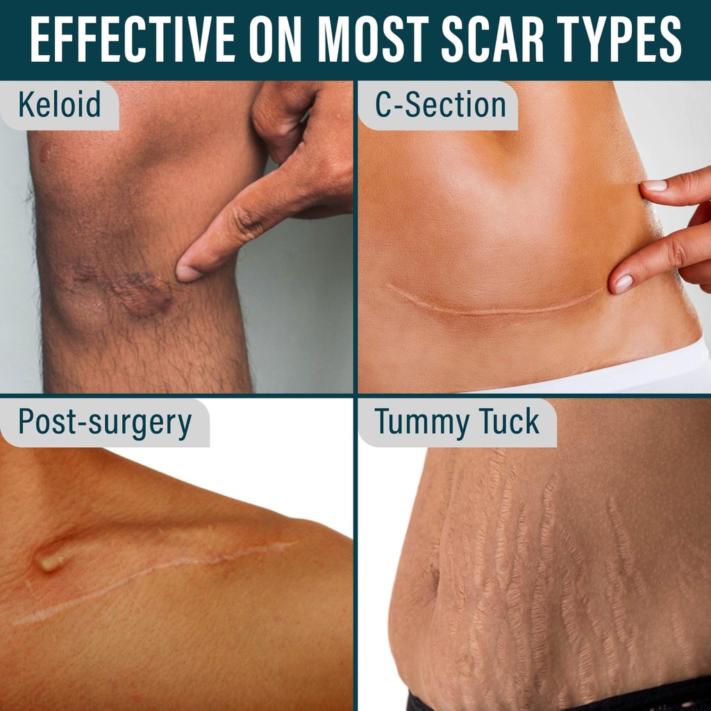 nuvadermis-silicone-scar-sheets-for-surg-5.jpg