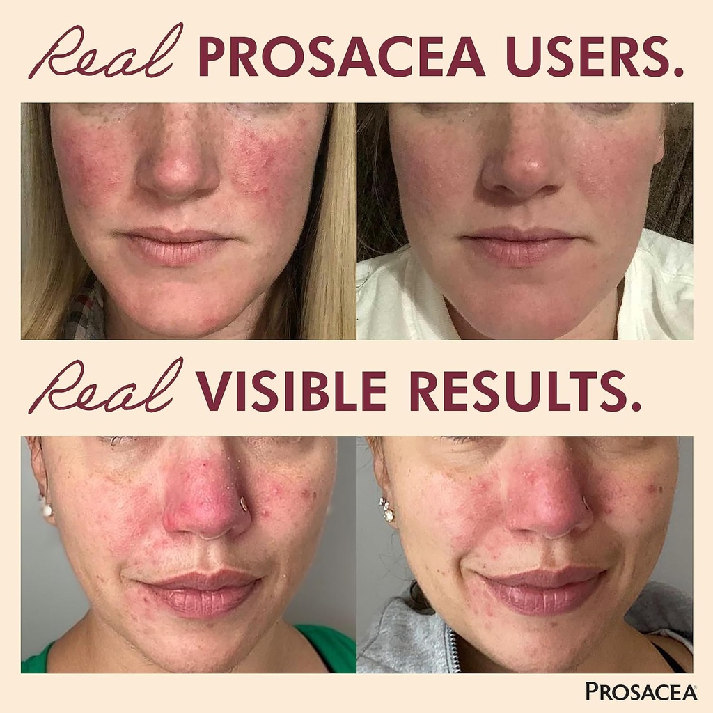 prosacea-heals-rosacea-symptoms-of-redne-2.jpg
