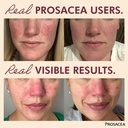 prosacea-heals-rosacea-symptoms-of-redne-2.jpg