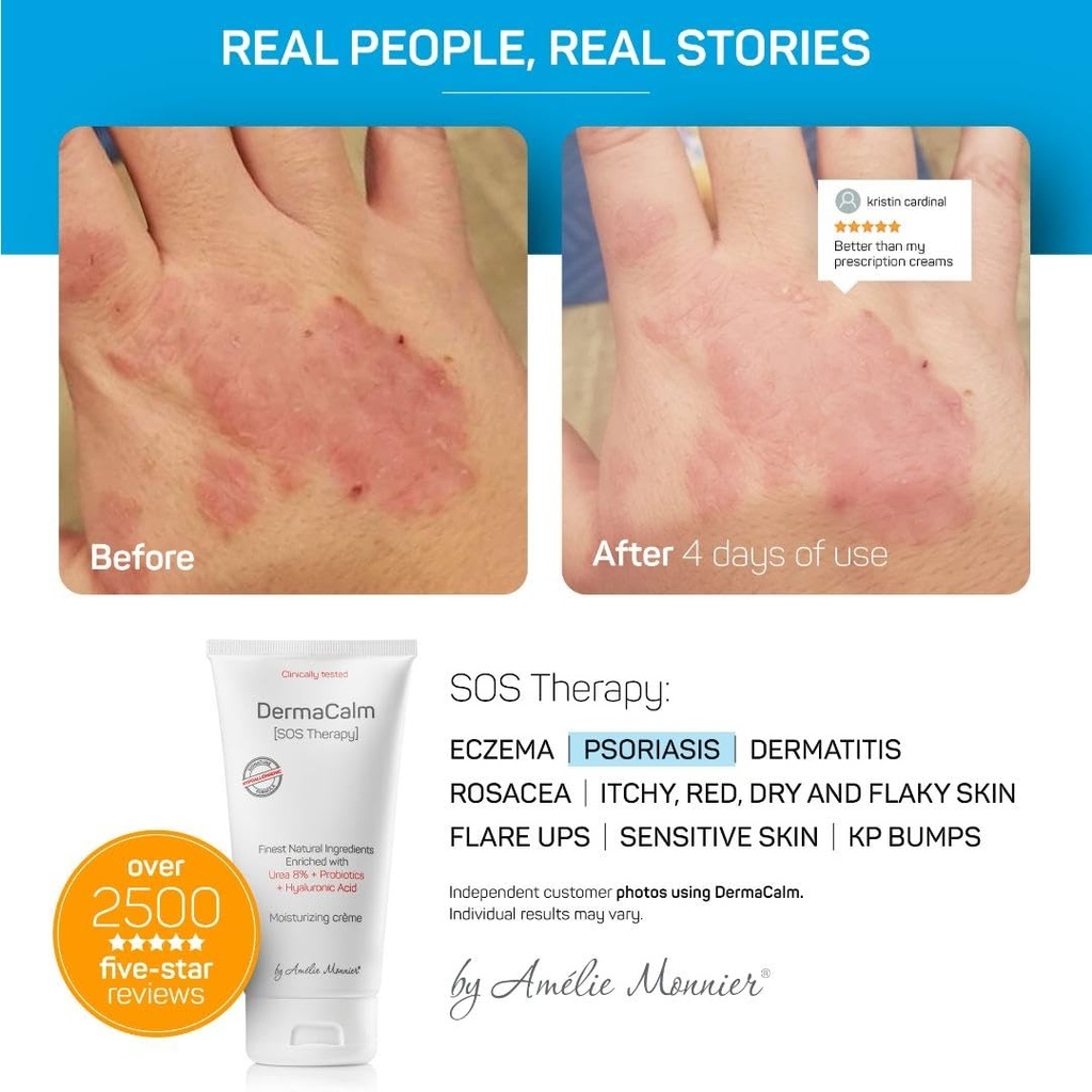 clinically-tested-dermacalm-sos-therapy--3.jpg
