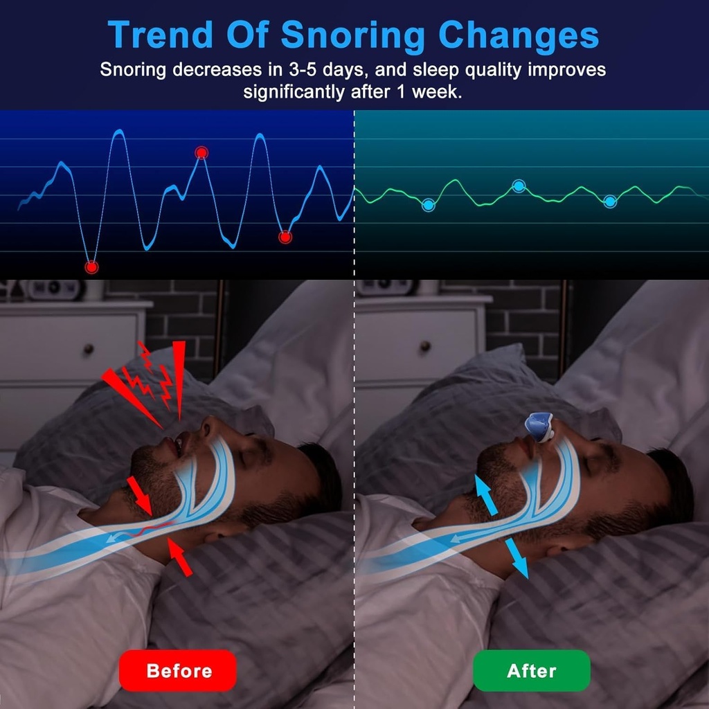 anti-snoring-device-mini-sleepapnea-devi-3.jpg