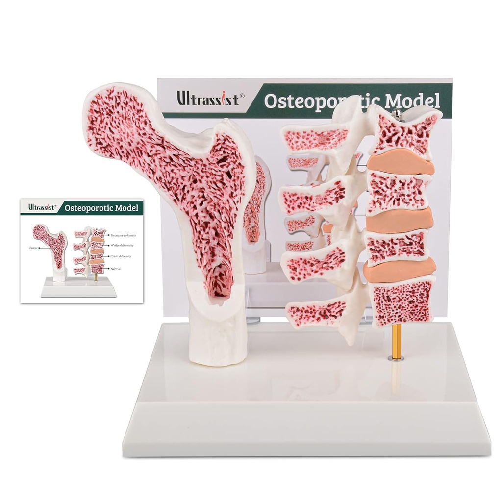 Modelo de Osteoporosis Humana Ultrasista, Modelo de Esqueleto Anatómico Vertebrae con Tarjeta de Estudio para la Demostración Estudiante Médica